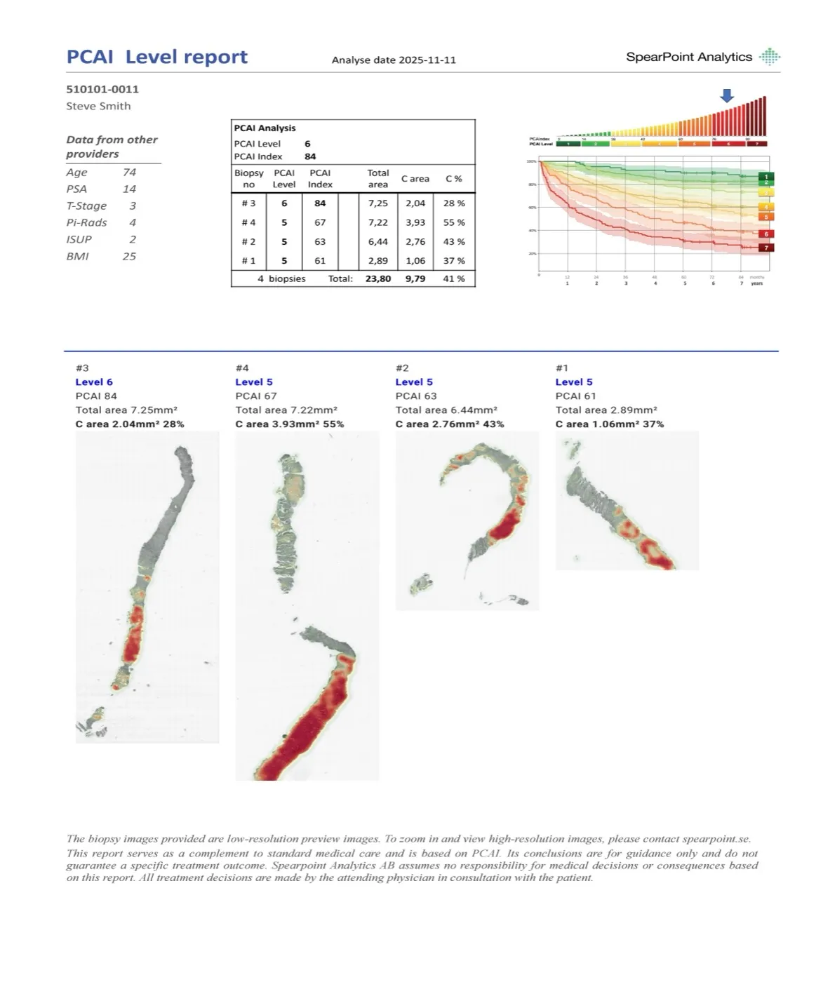 Exempel på en PCAI-rapport med index, risknivå och färgmarkerade cancerområden i fyra biopsier